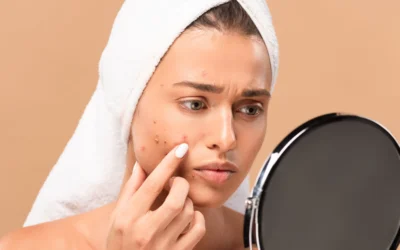 5 Reasons to Consider IPL for Stubborn Acne and Redness